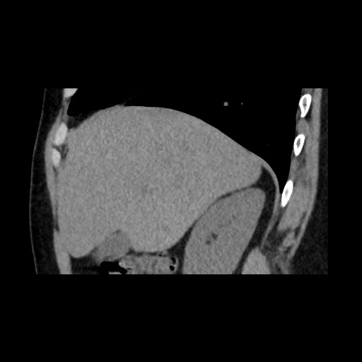 Adrenal gland trauma (Radiopaedia 81351-95079 Sagittal non-contrast 26).jpg