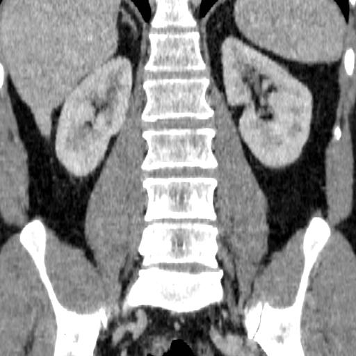 File:Adrenal glands (normal CT anatomy) (Radiopaedia 16570-105725 Coronal 16).jpg