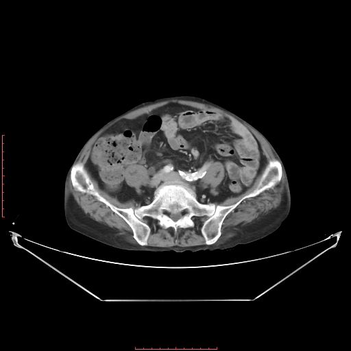 Adrenal hemangioma (Radiopaedia 68923-78668 Axial C+ portal venous phase 50).jpg