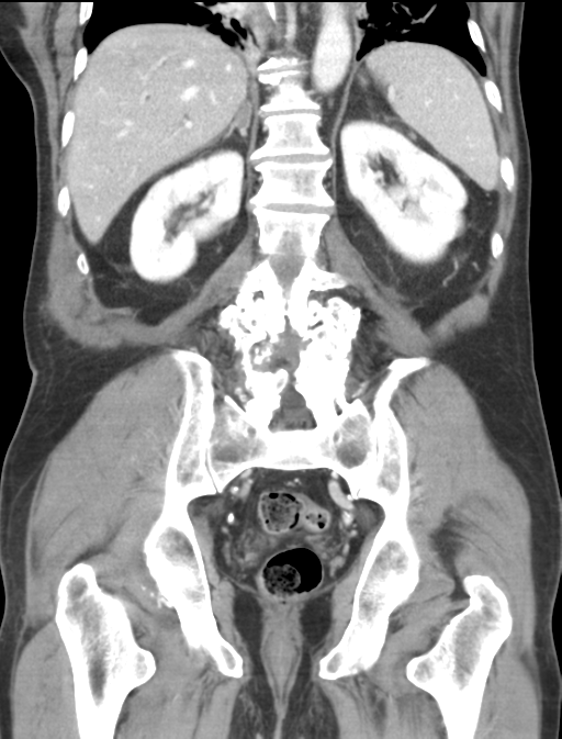 Adrenal hematoma (Radiopaedia 44334-47968 Coronal C+ portal venous phase 36).png