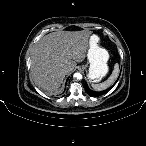 Adrenal hemorrhage (Radiopaedia 62622-70916 Axial C+ arterial phase 56).jpg