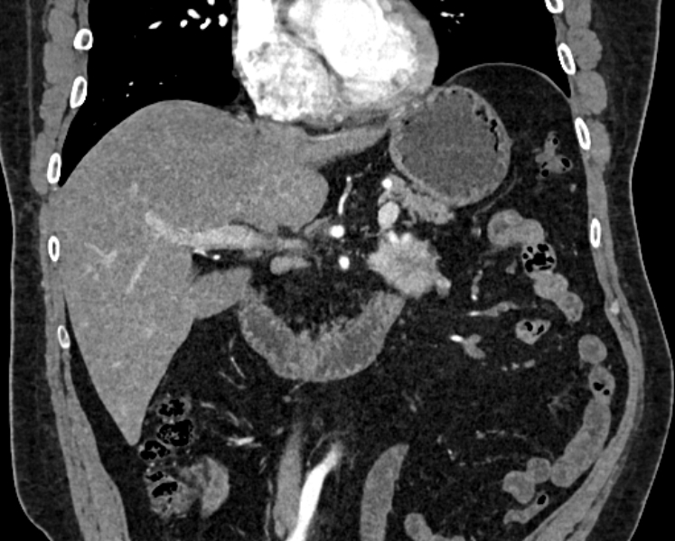 Adrenal metastases (Radiopaedia 73082-83791 Coronal C+ arterial phase 11).jpg