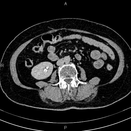 Adrenal myelolipoma (Radiopaedia 82742-96986 Axial renal excretory phase 82).jpg