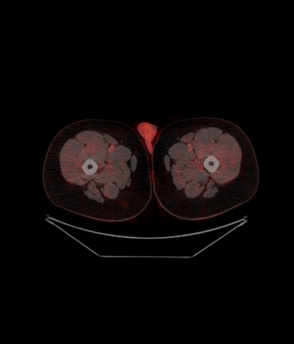 Adrenocortical carcinoma (Radiopaedia 80134-93440 ِAxial 291).jpg