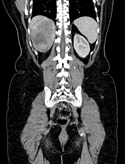 Adrenocortical carcinoma (Radiopaedia 87281-103569 Coronal C+ portal venous phase 114).jpg