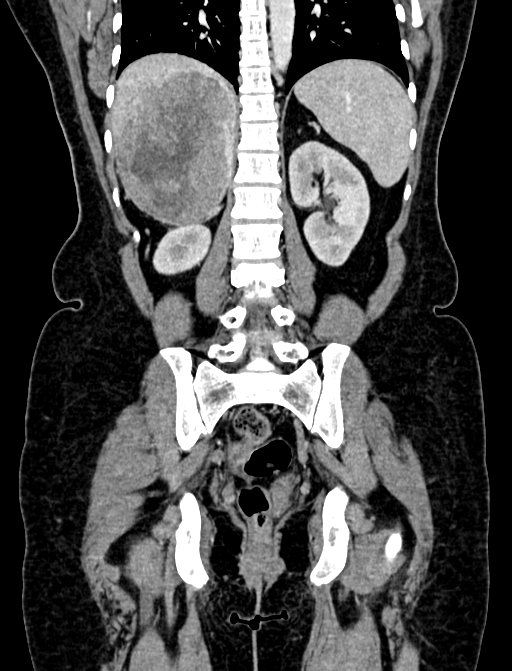 Adrenocortical carcinoma (Radiopaedia 87281-103569 Coronal C+ portal venous phase 92).jpg