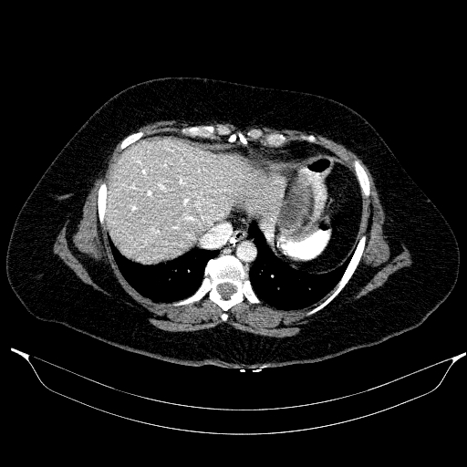 Afferent loop syndrome - secondary to incarcerated trocar site hernia (Radiopaedia 82959-97305 Axial C+ portal venous phase 29).jpg