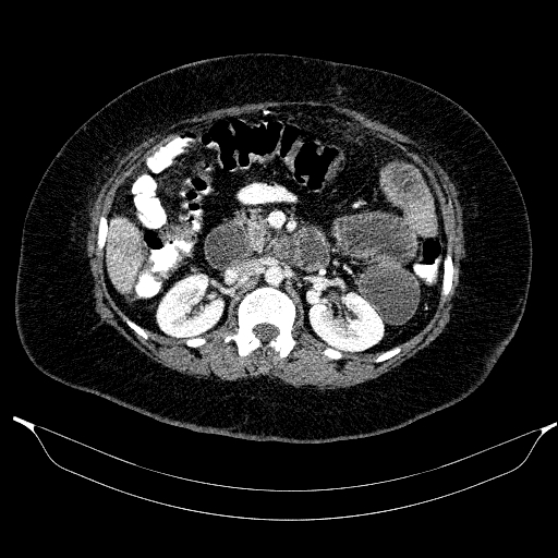 Afferent loop syndrome - secondary to incarcerated trocar site hernia (Radiopaedia 82959-97305 Axial C+ portal venous phase 95).jpg