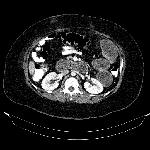 Afferent loop syndrome - secondary to incarcerated trocar site hernia (Radiopaedia 82959-97305 Axial C+ portal venous phase 99).jpg