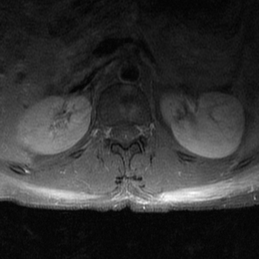 File:Aggressive vertebral hemangioma (Radiopaedia 39937-42404 Axial T1 C+ fat sat 2).png