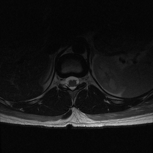 File:Aggressive vertebral hemangioma (Radiopaedia 39937-42404 Axial T2 7).png