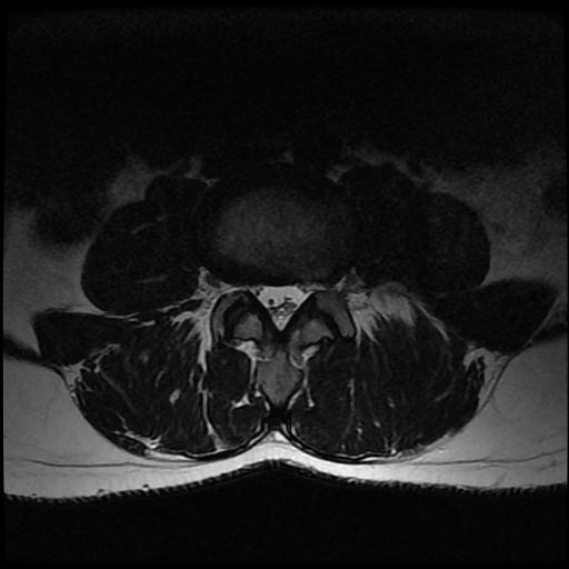 File:Aggressive vertebral hemangioma with pathological fracture (Radiopaedia 69528-79411 Axial T2 7).jpg