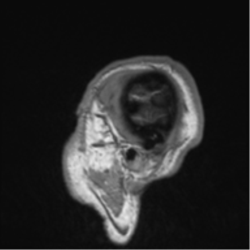 File:Alzheimer's disease- with Gerstmann syndrome and dressing apraxia (Radiopaedia 54882-61150 Sagittal T1 2).png