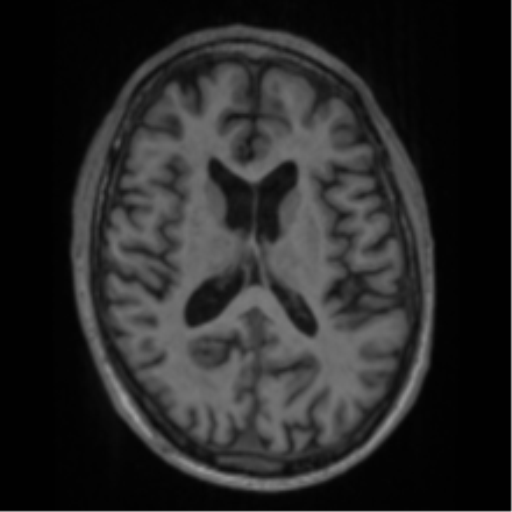 Alzheimer's disease- with apraxia (Radiopaedia 54763-61011 Axial T1 43).png