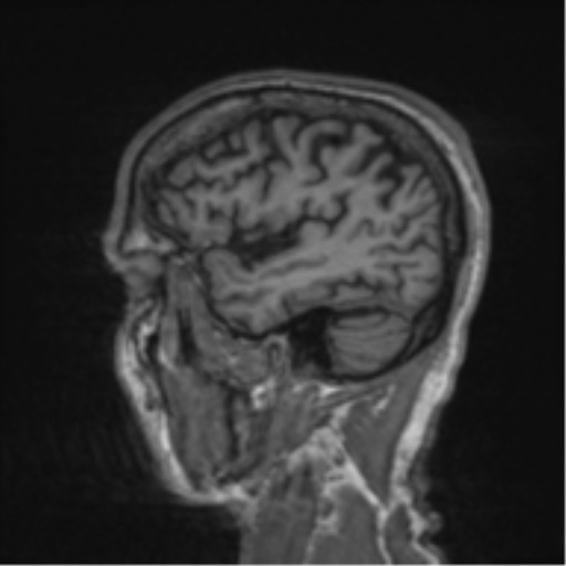 File:Alzheimer's disease- with apraxia (Radiopaedia 54763-61011 Sagittal T1 57).png