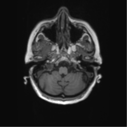File:Alzheimer's disease (Radiopaedia 42658-45802 Axial T1 126).png