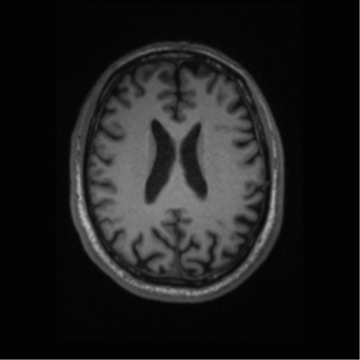 File:Alzheimer disease - probable (Radiopaedia 35334-36837 Axial T1 48).png