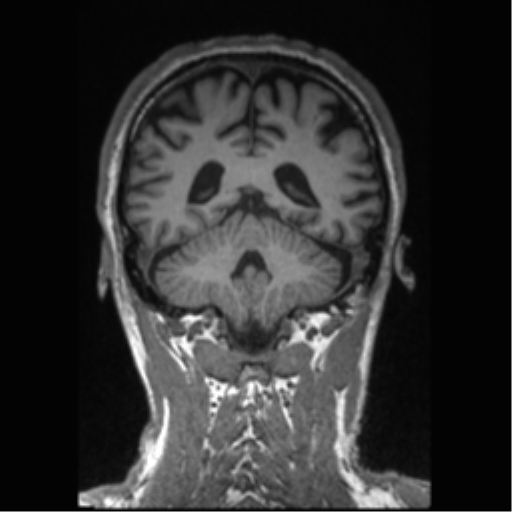 Alzheimer disease - probable (Radiopaedia 35334-36837 Coronal T1 31).png