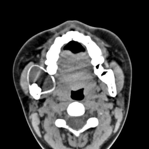 File:Ameloblastoma (Radiopaedia 26645-26793 Axial C+ delayed 21).jpg