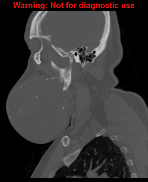 Ameloblastoma (Radiopaedia 33126-34164 Sagittal bone window 23).jpg