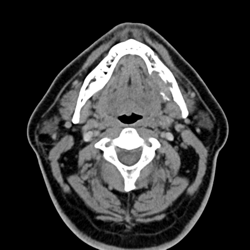 File:Ameloblastoma (Radiopaedia 38520-40623 Axial non-contrast 33).png