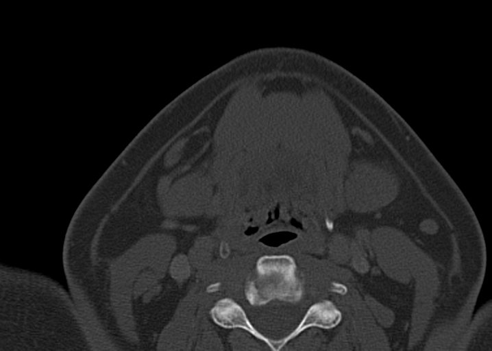 Ameloblastoma (Radiopaedia 38520-40623 D 42).png