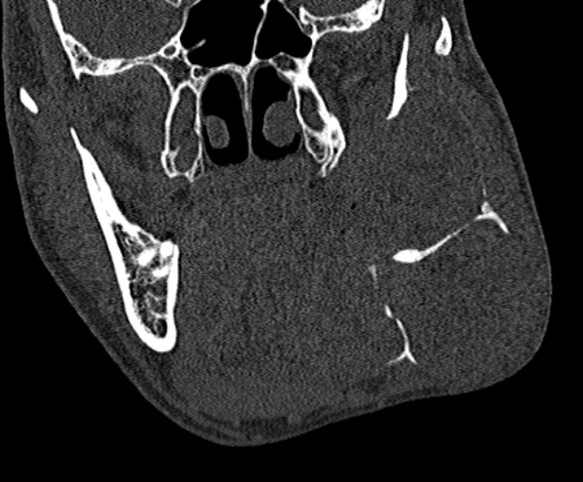 Ameloblastoma (Radiopaedia 51921-57766 Coronal bone window 119).jpg