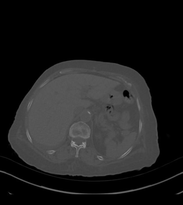 Amiodarone deposition in the liver (Radiopaedia 77587-89780 Axial bone window 80).jpg