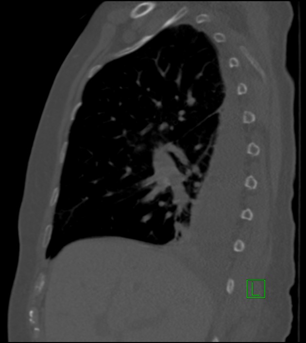Amiodarone deposition in the liver (Radiopaedia 77587-89780 Sagittal bone window 67).jpg