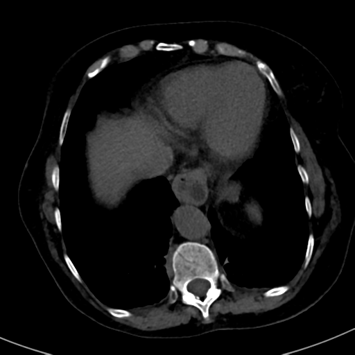 File:Ampullary adenocarcinoma (Radiopaedia 34013-35241 AXIAL THICK 8).png