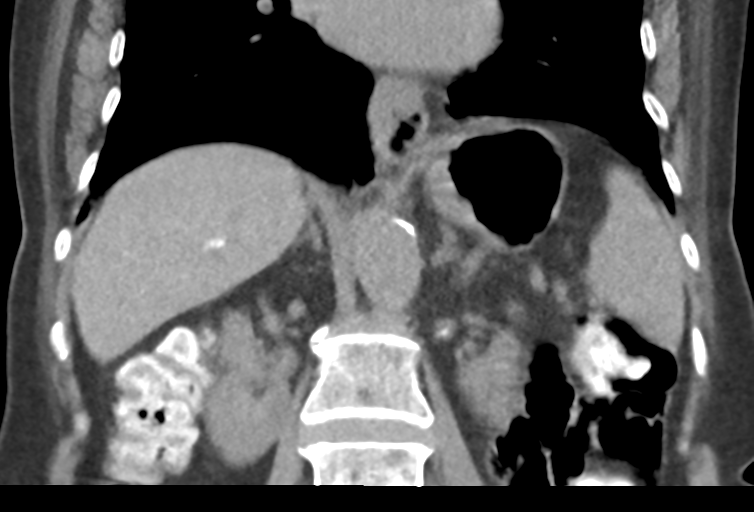 Ampullary adenocarcinoma (Radiopaedia 34013-35241 Coronal 30).png