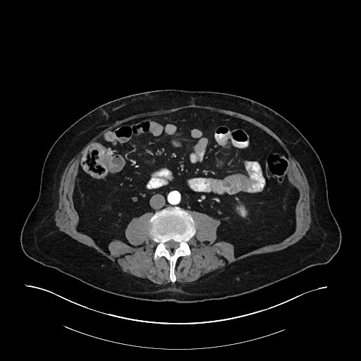 Ampullary adenocarcinoma (Radiopaedia 59373-66734 A 94).jpg