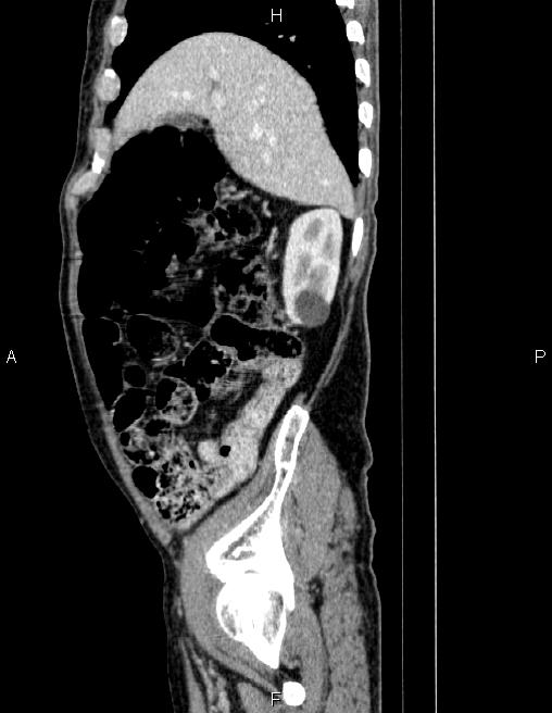 Ampullary adenocarcinoma (Radiopaedia 86093-102032 D 20).jpg