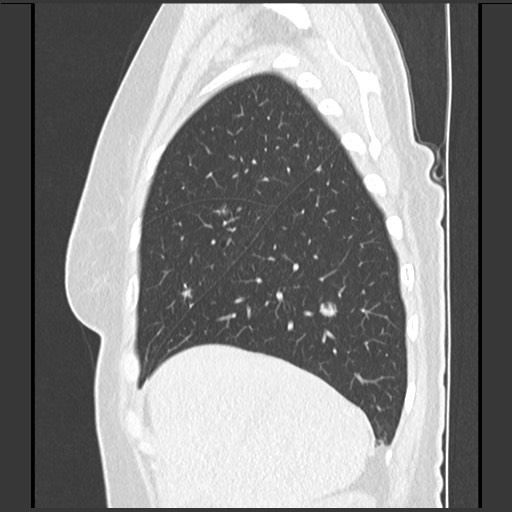Amyloidosis - bronchial and diffuse nodular pulmonary involvement (Radiopaedia 60156-67744 F 12).jpg