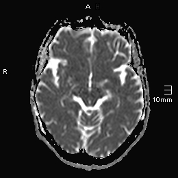 File:Amyotrophic lateral sclerosis (Radiopaedia 70821-81017 Axial ADC 10).jpg