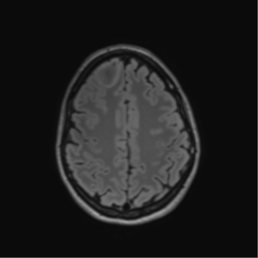 File:Anaplastic astrocytoma IDH mutant (Radiopaedia 50046-55341 Axial FLAIR 37).png