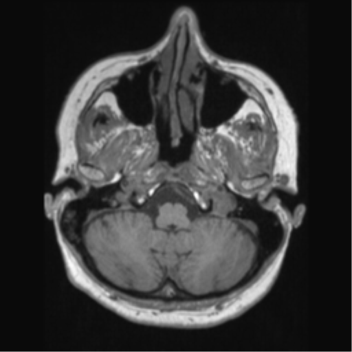 File:Anaplastic astrocytoma IDH wild-type (pseudoprogression) (Radiopaedia 42209-45276 Axial T1 33).png