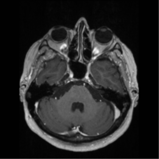 File:Anaplastic astrocytoma IDH wild-type (pseudoprogression) (Radiopaedia 42209-45276 Axial T1 C+ 46).png