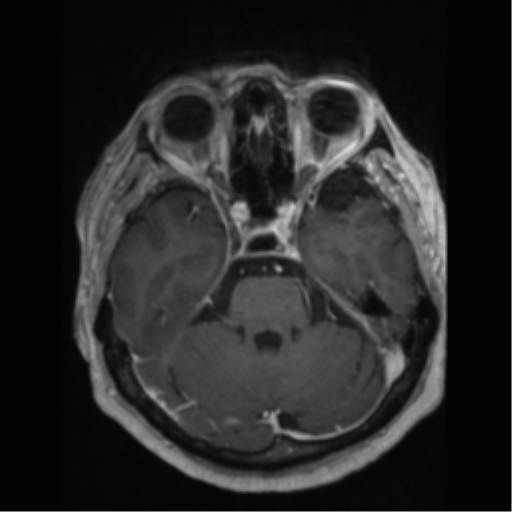File:Anaplastic astrocytoma IDH wild-type (pseudoprogression) (Radiopaedia 42209-45277 Axial T1 C+ 37).png