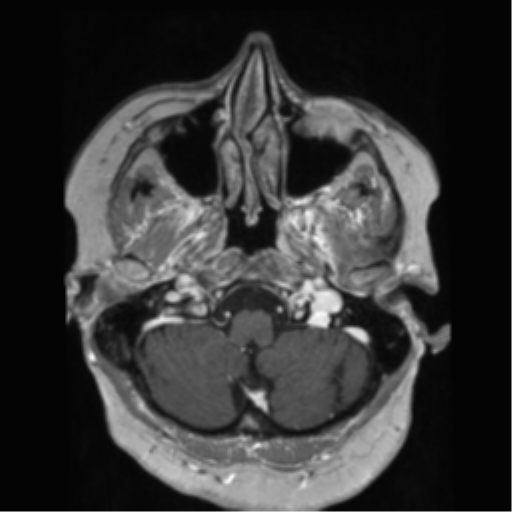 File:Anaplastic astrocytoma IDH wild-type (pseudoprogression) (Radiopaedia 42209-45278 Axial T1 C+ 34).png