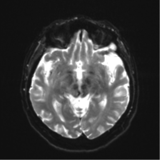 Anaplastic astrocytoma IDH wild-type (pseudoprogression) (Radiopaedia 42209-45279 Axial DWI 12).png