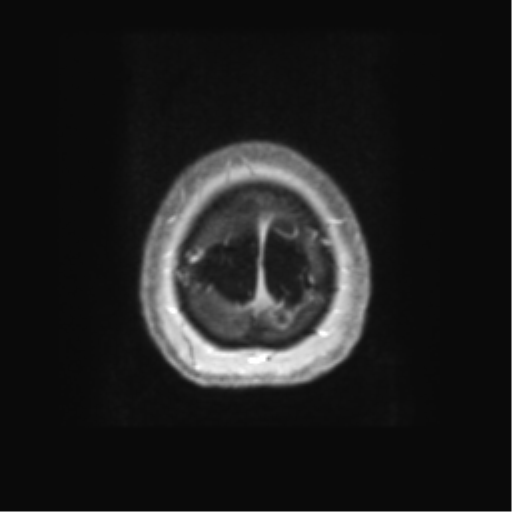 Anaplastic astrocytoma IDH wild-type (pseudoprogression) (Radiopaedia 42209-45279 Axial T1 C+ 136).png
