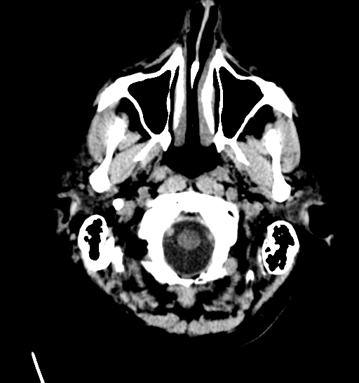 File:Anaplastic meningioma with recurrence (Radiopaedia 34452-35786 Axial non-contrast 3).png