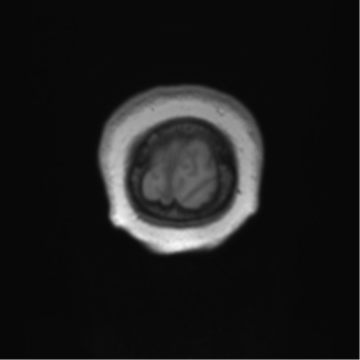 Anaplastic oligodendroglioma (Radiopaedia 83500-98599 Coronal T1 7).png