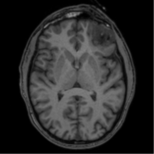 Anaplastic oligodendroglioma with skull fracture (Radiopaedia 74831-85845 Axial T1 33).png