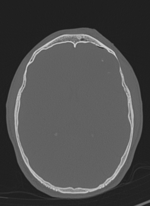 Anaplastic oligodendroglioma with skull fracture (Radiopaedia 74831-85846 Axial bone window 30).png