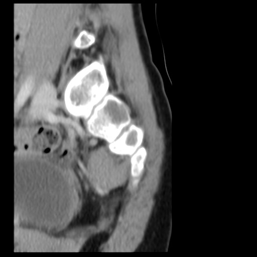 File:Aneurysmal bone cyst - sacrum (Radiopaedia 65190-74195 A 6).jpg