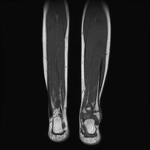 File:Aneurysmal bone cyst - tibia (Radiopaedia 22343-22367 Coronal T1 14).jpg