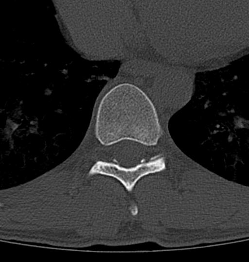 Aneurysmal bone cyst T11 (Radiopaedia 29294-29721 Axial bone window 25).jpg