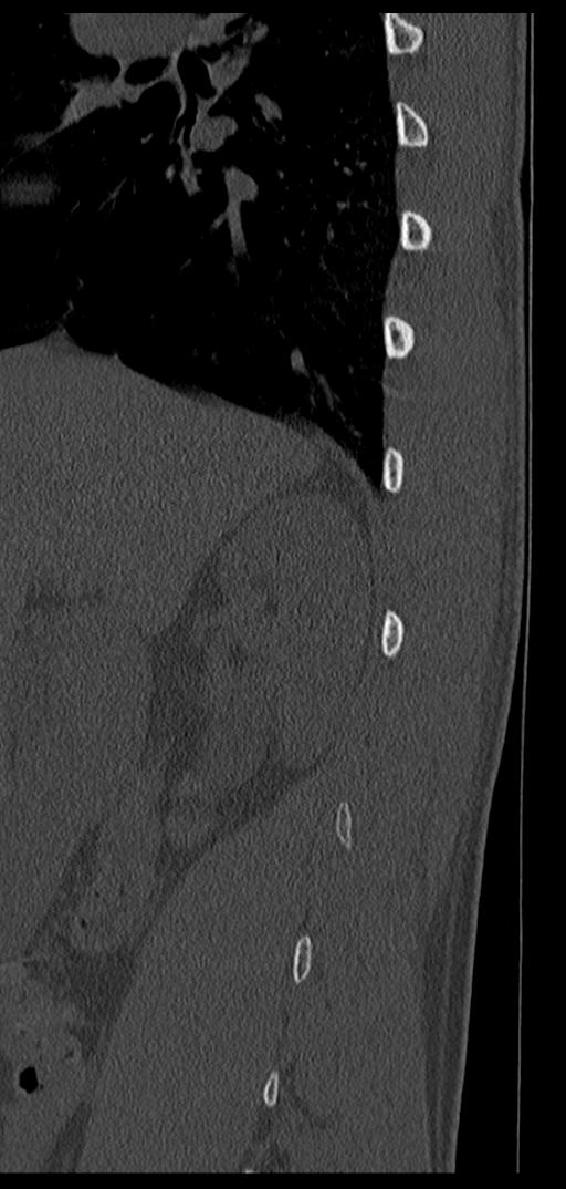 Aneurysmal bone cyst T11 (Radiopaedia 29294-29721 Sagittal bone window 68).jpg